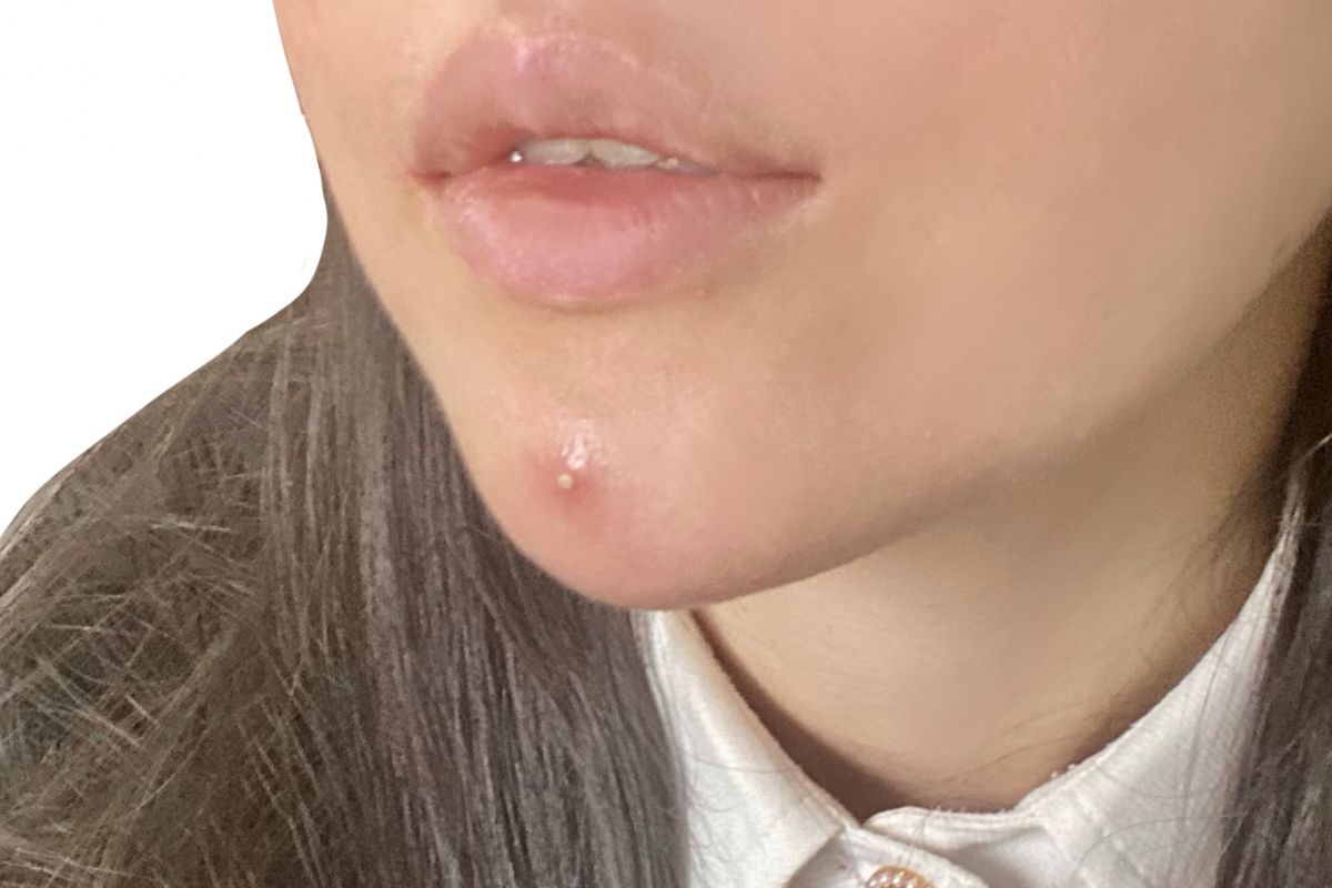 大人ニキビと思春期ニキビの違い｜原因・できる場所・正しいケア方法を専門家目線で解説