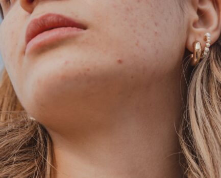 大人ニキビにおすすめの市販薬｜薬剤師が教える選び方とランキング