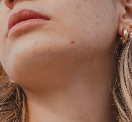 大人ニキビにおすすめの市販薬｜薬剤師が教える選び方とランキング